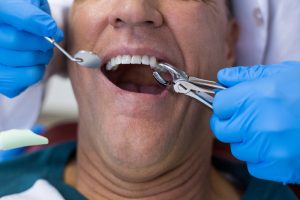 Extracciones Dentales​