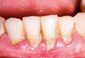 Periodoncias1