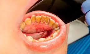 Periodoncias2
