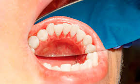 Periodoncias3