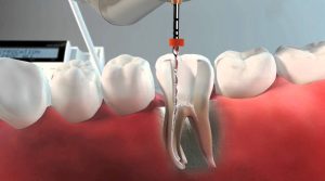 Que-es-una-endodoncia-y-para-que-sirve
