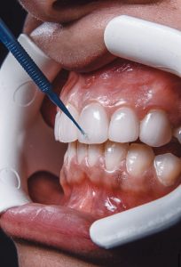 Restauración dental​1
