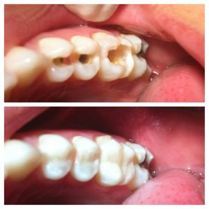 Restauración dental​2