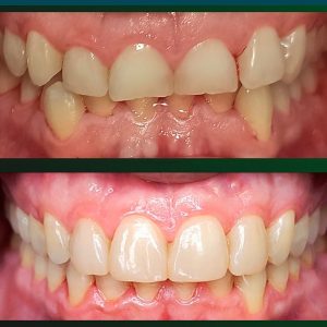 Restauración dental​3