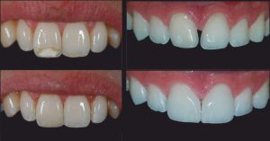 Restauración dental​4