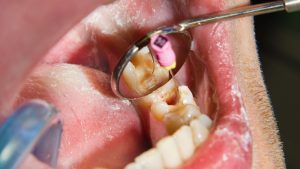 cuando-necesito-una-endodoncia