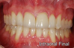 intraoralfinalok