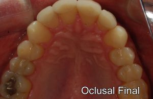 oclusalfinalok