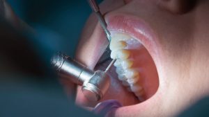 que-es-una-endodoncia-scaled